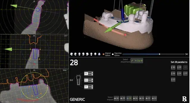 An in-depth snapshot of the different tools available with the X-guide system