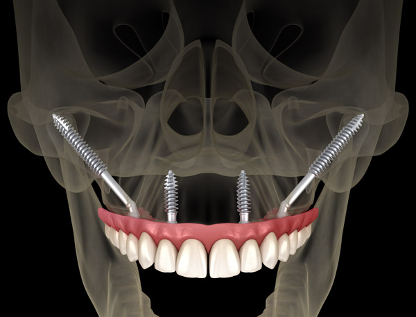 3D x-ray rendering of zygomatic implants placed in the upper jaw